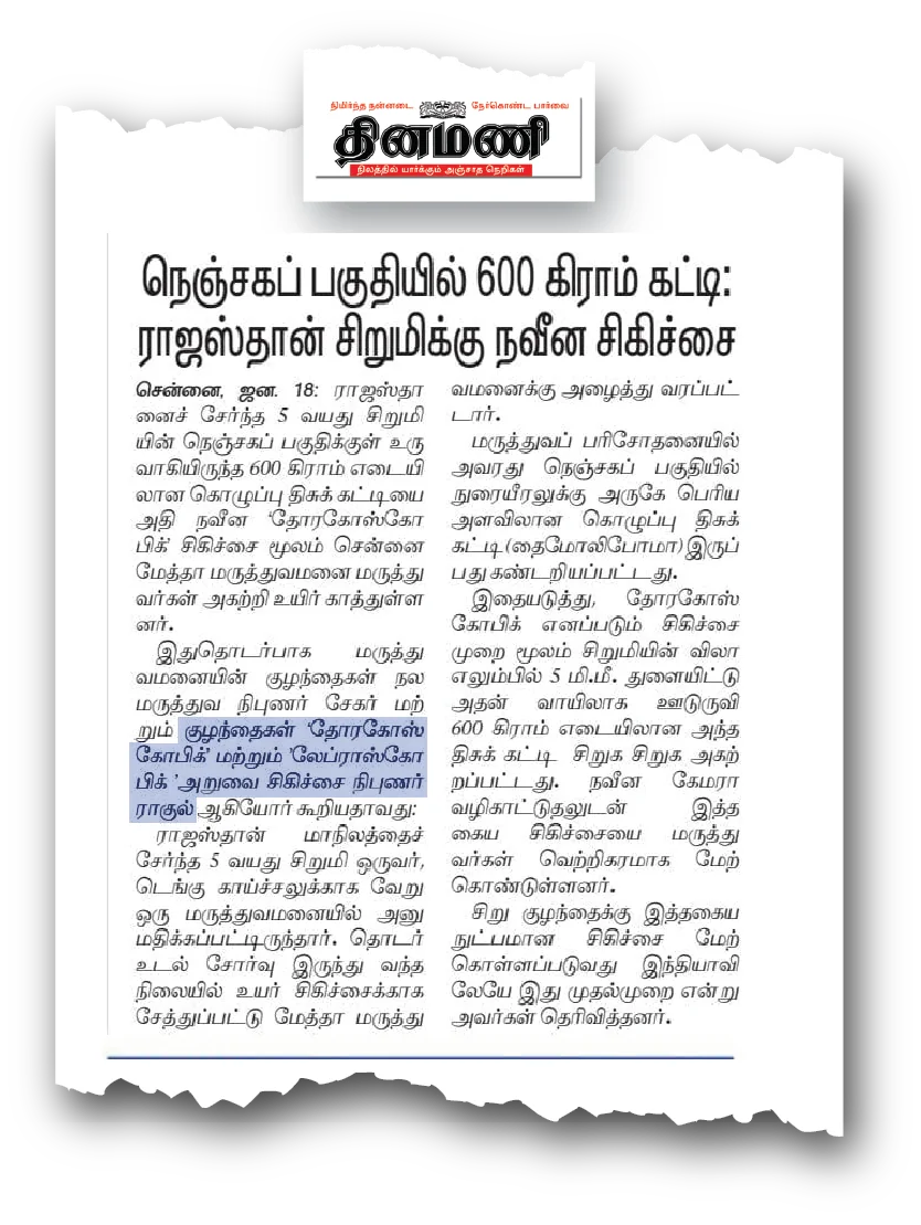 Dr. Raghul Maniam - 600g Chest Tumor Keyhole Surgery in Dinamani Dr. Raghul Maniam in Dinamani Tamil Daily: 5mm keyhole surgery removes 600g chest tumor in child at Dr. Mehta’s Hospital Chennai