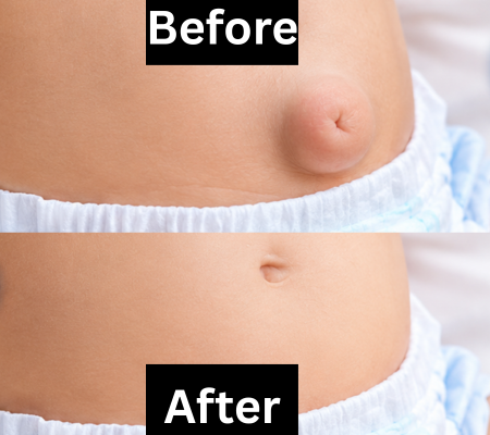 hernia-1-3