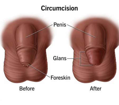 pediatric-circumicision