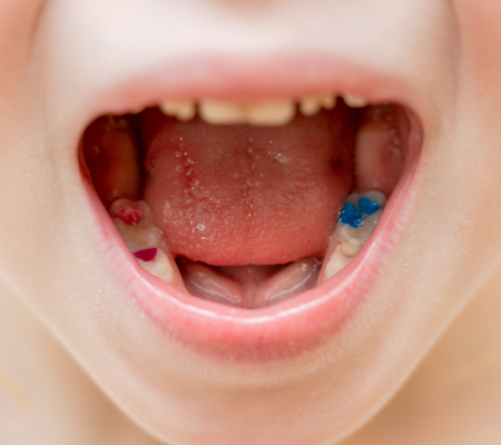 tongue-tie-1