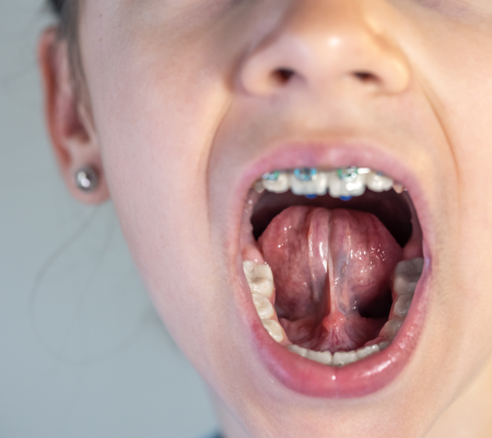 tongue-tie-2