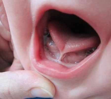 tongue-tie-3